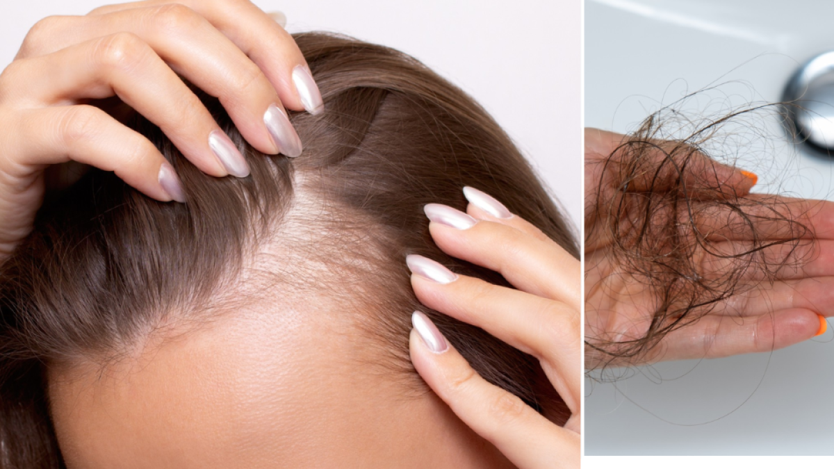 Alopecia por tracción: los peinados más comunes que pueden causar caída del cabello sin que lo note y las señales de alerta que no debe ignorar