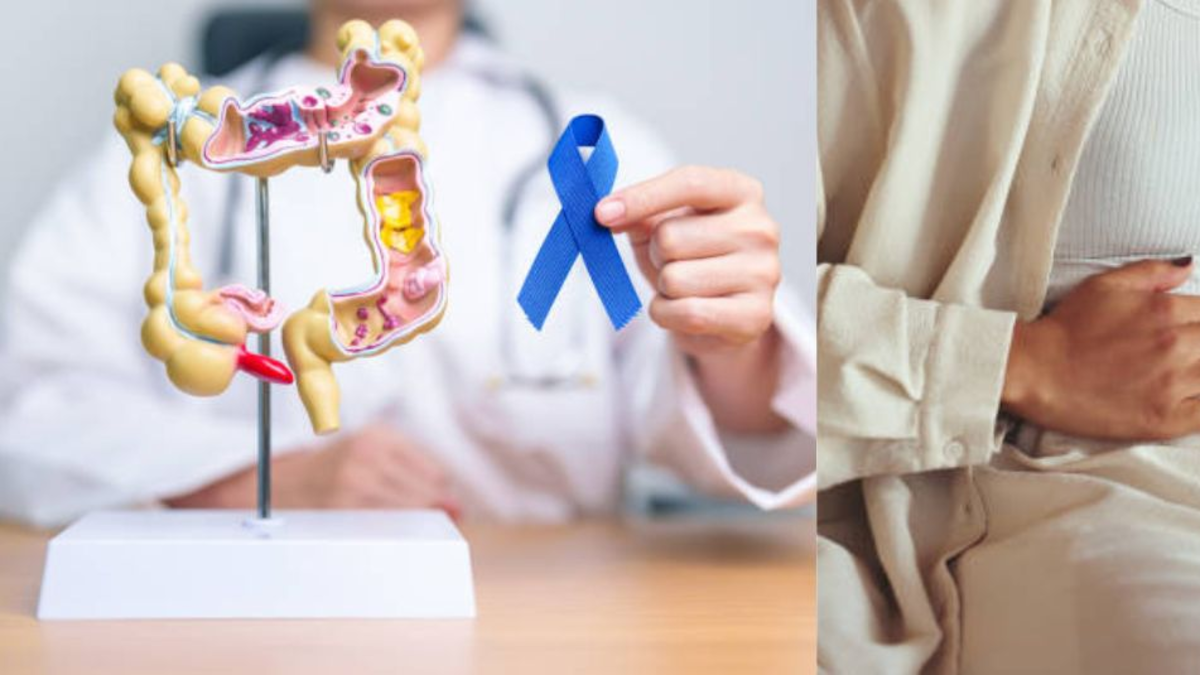 Seis señales del cáncer de intestino en su etapa inicial que no debe ignorar