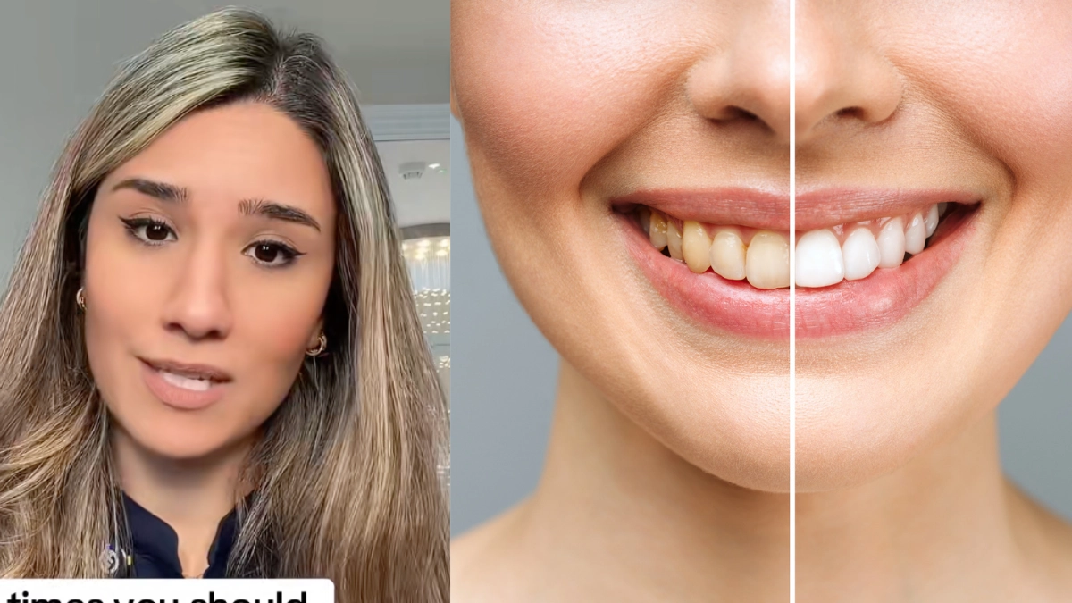 Un error común al cepillarse causa dientes amarillos, según odontóloga: lo que debe evitar tras cada comida