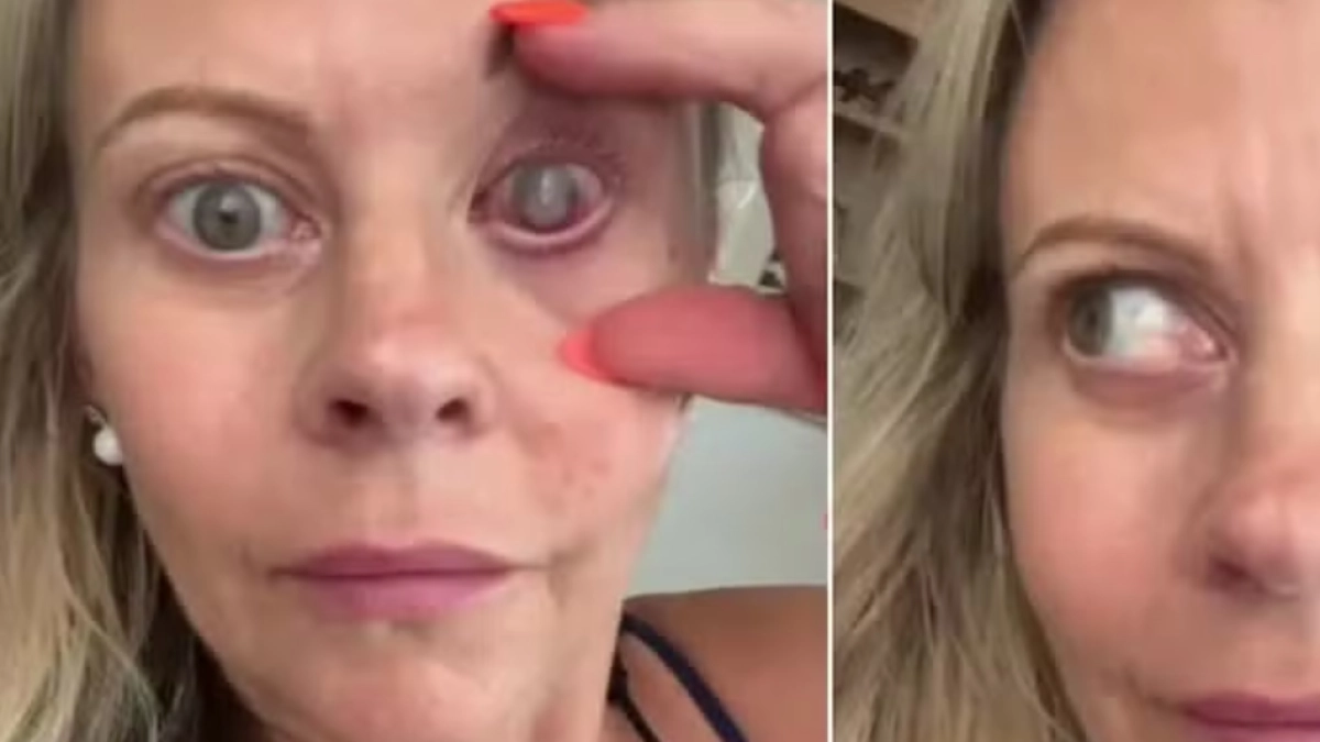 Mujer británica se lavó la cara con lentes de contacto puestos y un parásito 'devoró' su ojo derecho: 'El parto es un sueño comparado con este dolor'