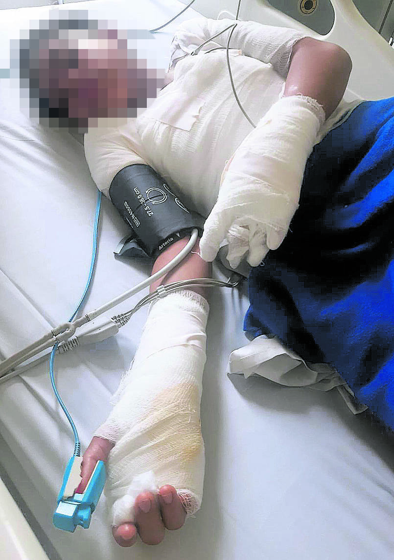 La menor fue atendida en el hospital Simón Bolívar, donde será sometida a varias cirugías.