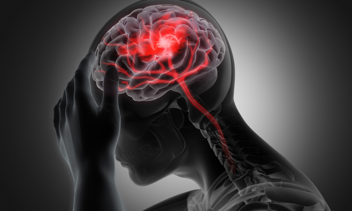 Ataque cerebrovascular: qué es, cómo identificar si está sufriendo uno ...