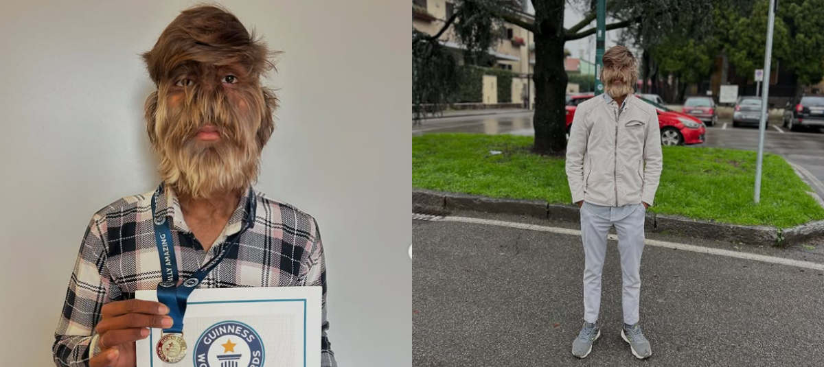 Jovem indiano de 18 anos ganha recorde do Guinness por ter 95% do rosto coberto de pelos