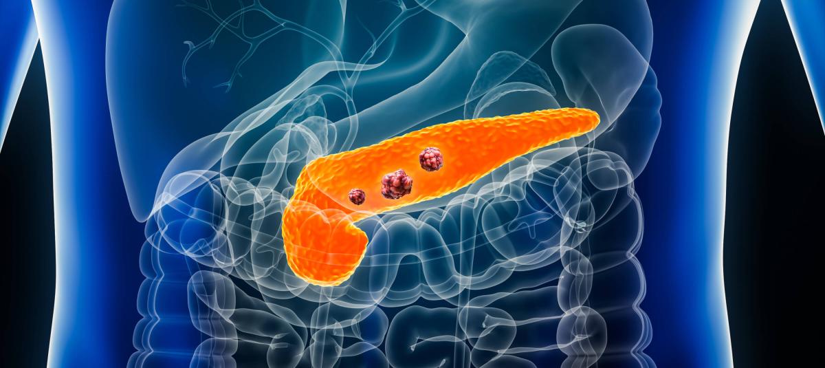 Cáncer de pancreas