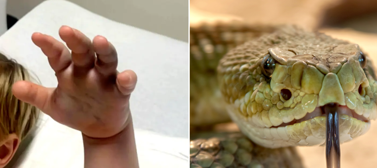 Niño de 4 años fue mordido por serpiente venenosa en Estados Unidos y guardería no llamó a emergencias porque pensó que era solo una astilla