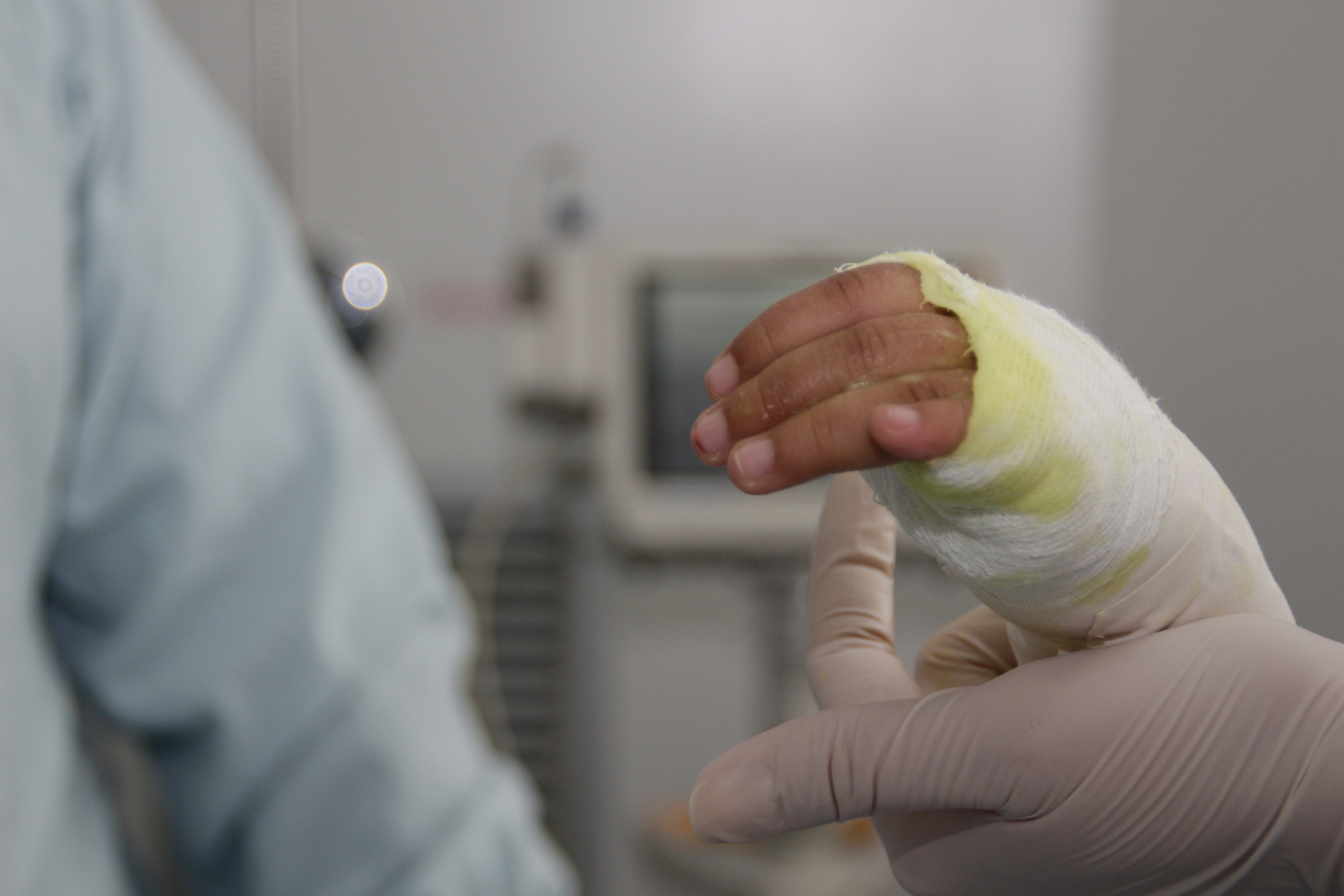 Quemaduras en el cuerpo