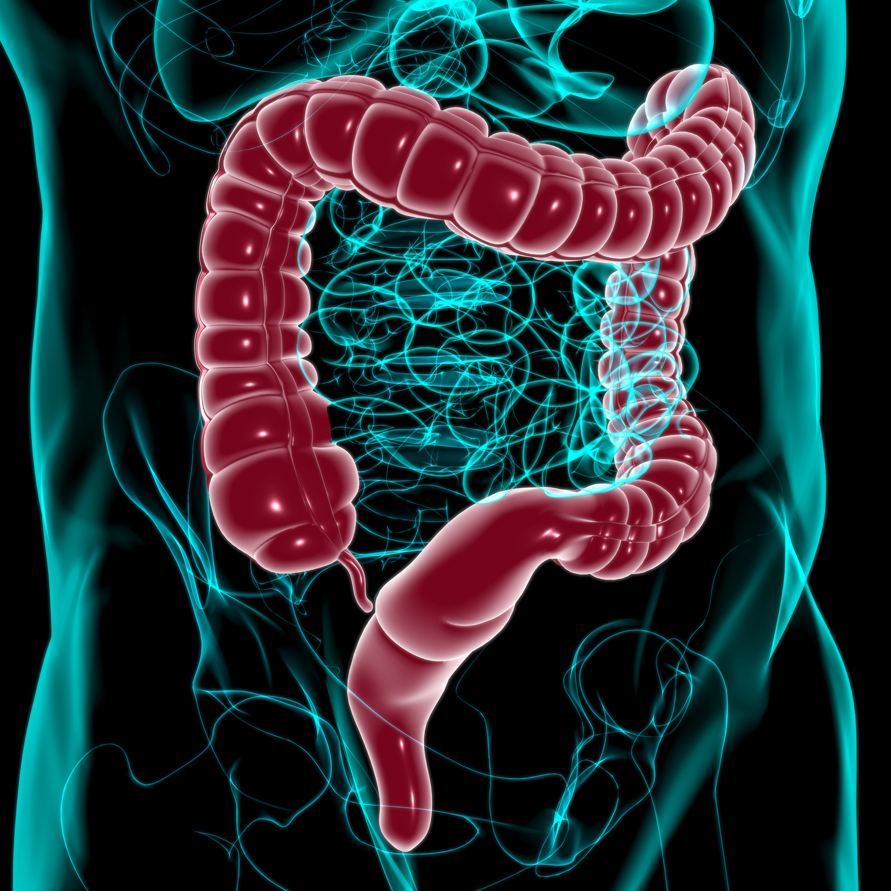 El cáncer de colon es una proliferación anormal de células