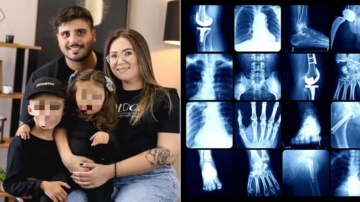 Mujer con enfermedad de huesos de cristal