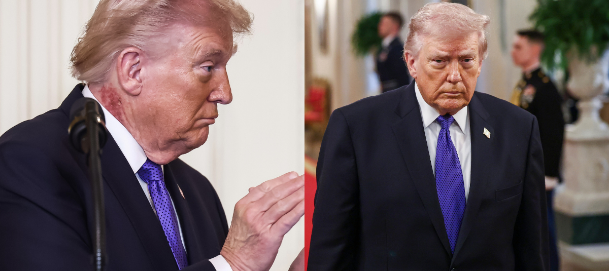 Donald Trump fue visto con un sarpullido en el cuello.