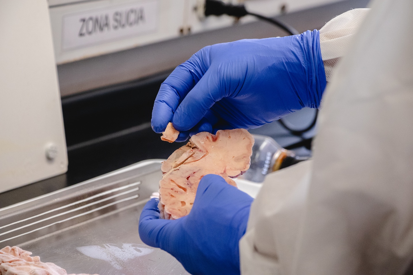 Estudio para prevenir el alzhéimer