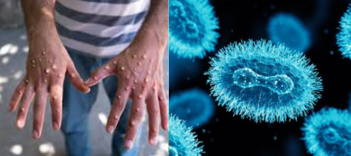 Ministerio de Salud confirma caso de mpox clado Ib en Antioquia.