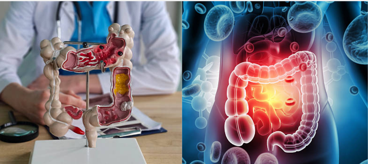 El cáncer colorrectal puede confundirse con problemas digestivos.