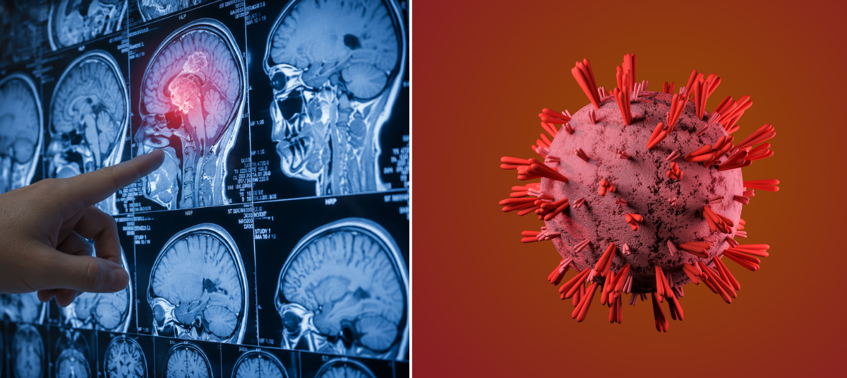 Cáncer cerebral.