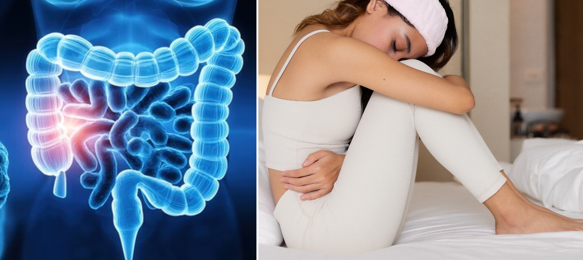Cáncer de colon en mujeres.